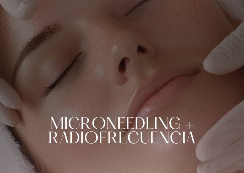 Microneedling + radiofrecuencia